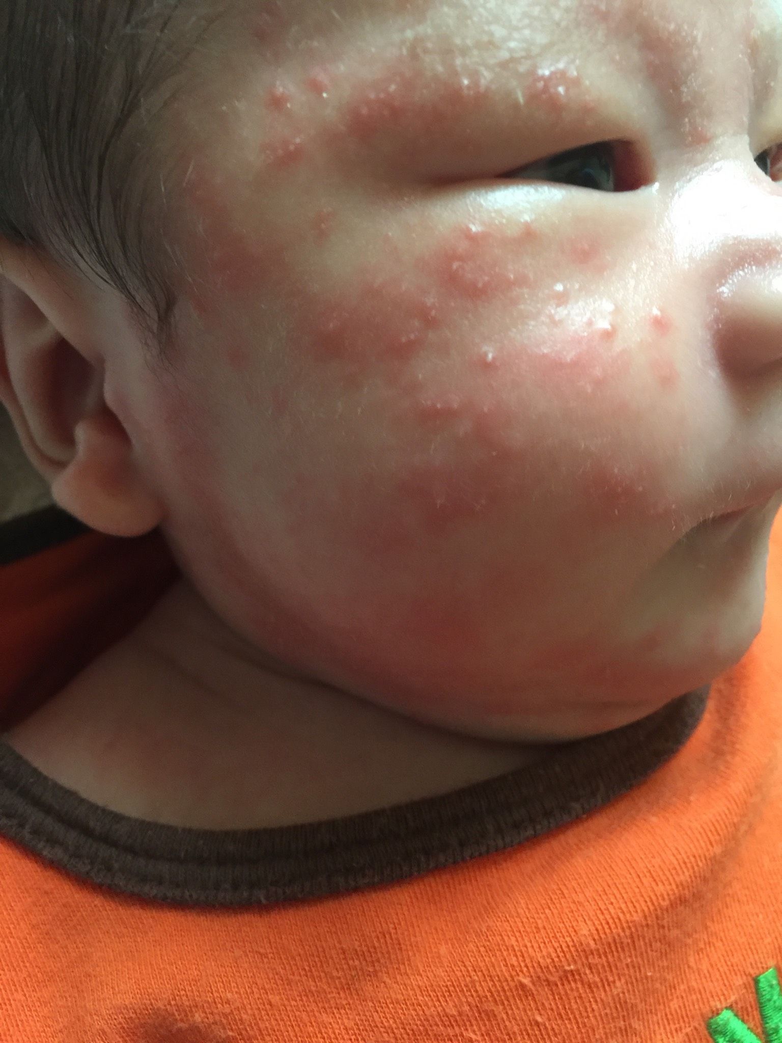 這是熱疹嗎？長在額頭頭皮｜寶寶健康板｜媽咪愛