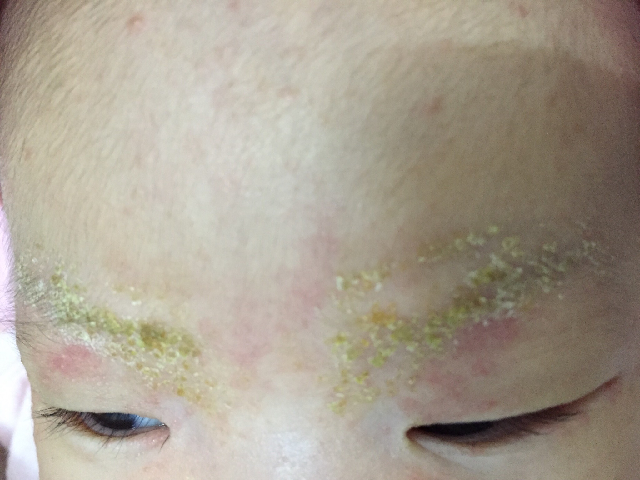 脂漏性皮膚炎 《媽咪愛》育兒問答 脂漏性皮膚炎 《媽咪愛》育兒問答